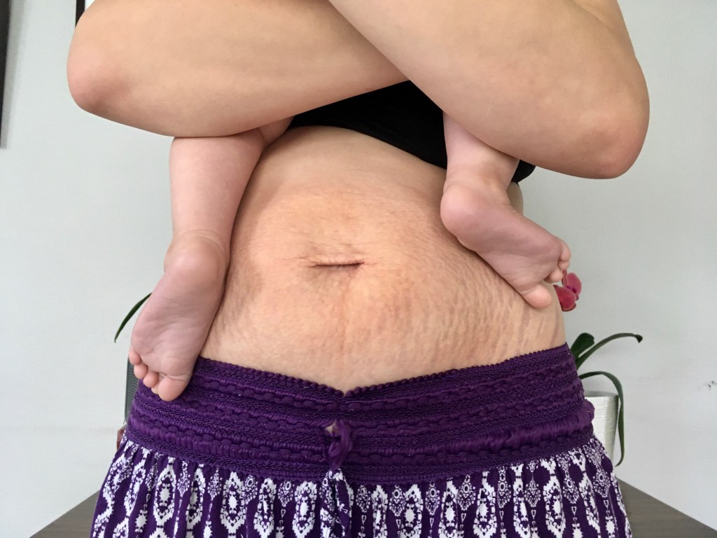 Glorified Stretch Marks